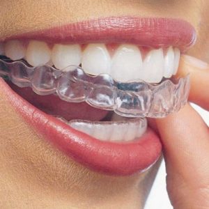 Dentist Temple TX  What are Invisalign clear braces?